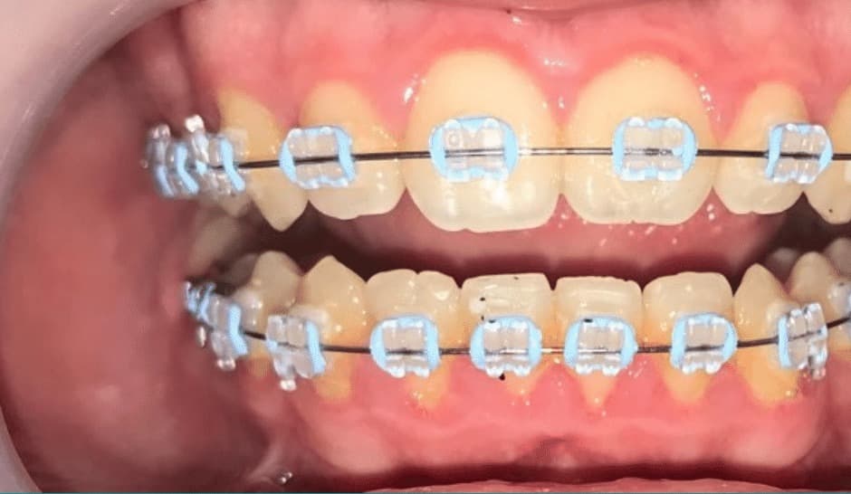 Aparat ortodontic fix – rezultat după 3 luni – rezultat final