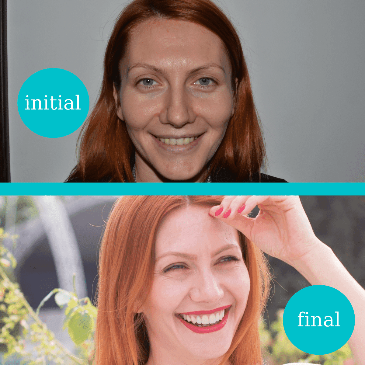 Fațete și coroane dentare integral ceramice