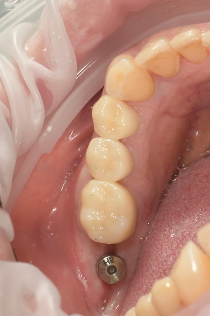 3 coroane din zirconia + coroană pe implant