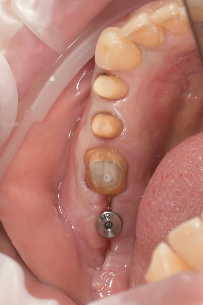 3 coroane din zirconia + coroană pe implant – before