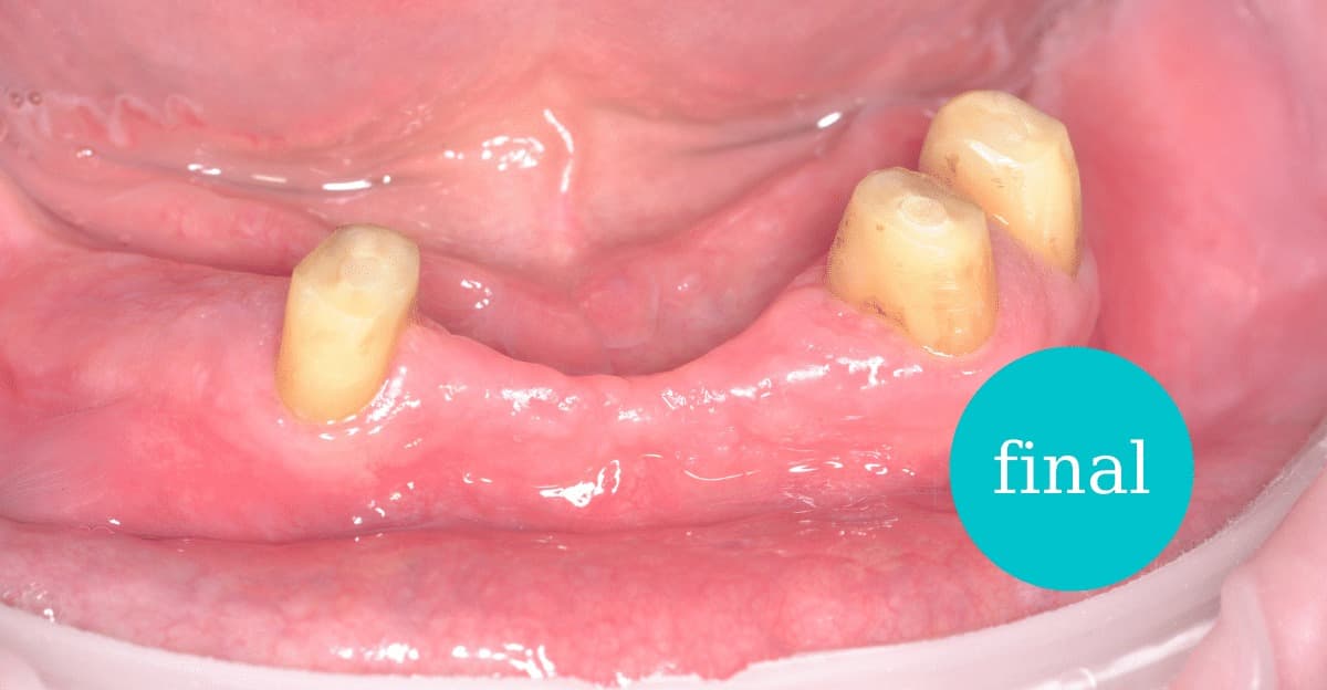 Excizie tumori gingivale – rezultat final