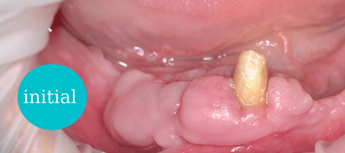 Excizie tumori gingivale – starea inițială