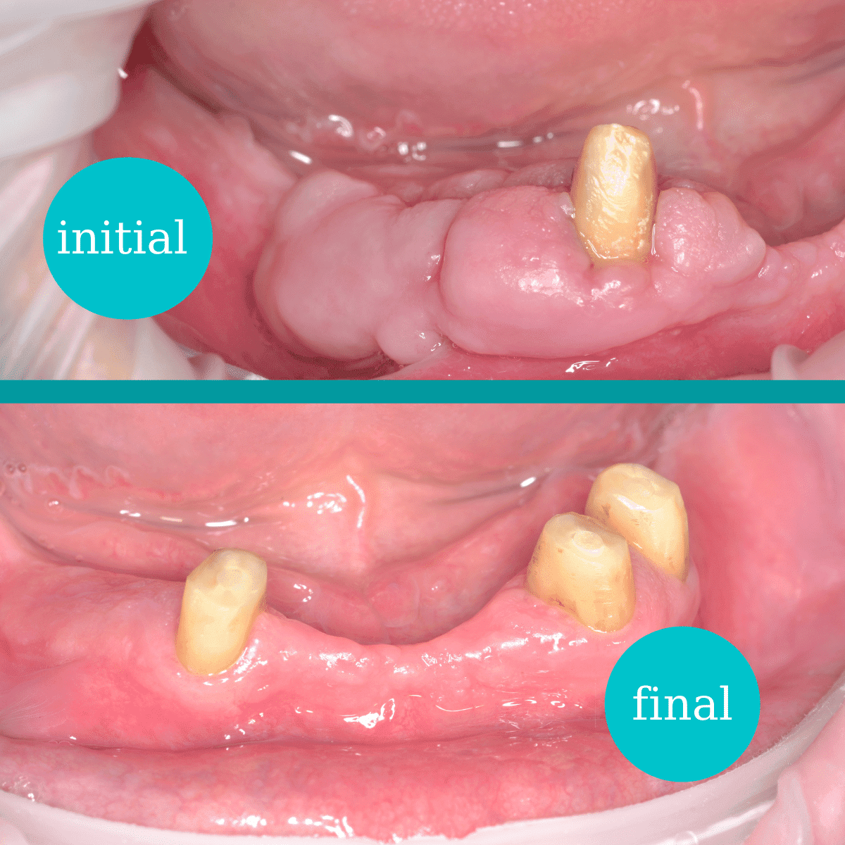 Excizie tumori gingivale