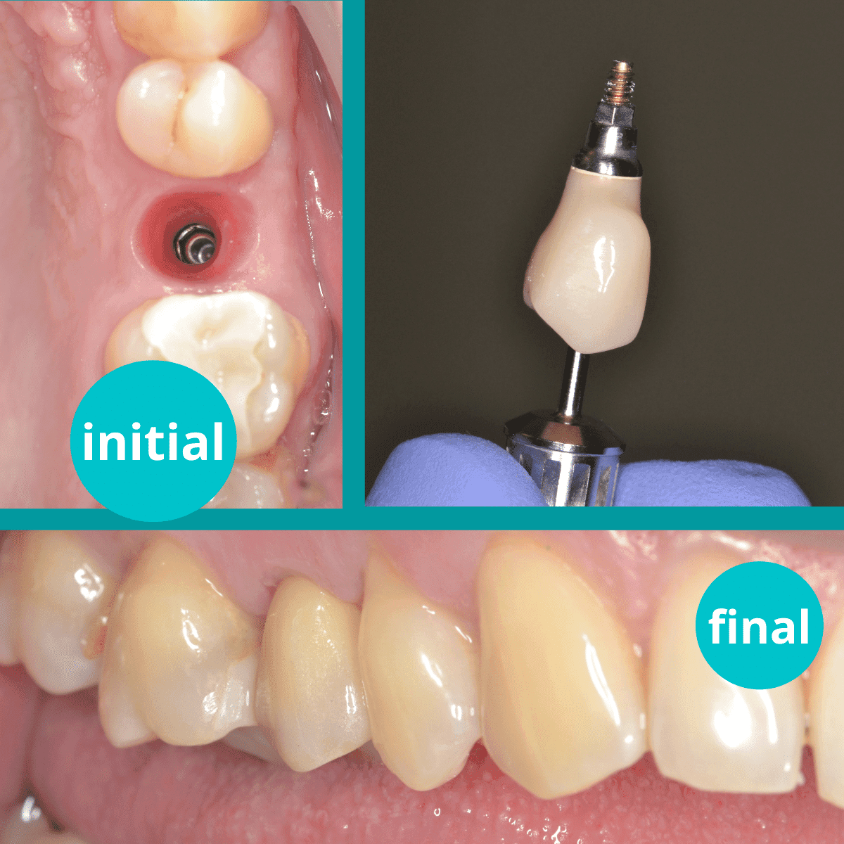 Implant postextractional premolar superior