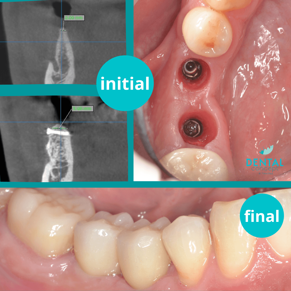 Adiție bone plate & inserarea de implanturi
