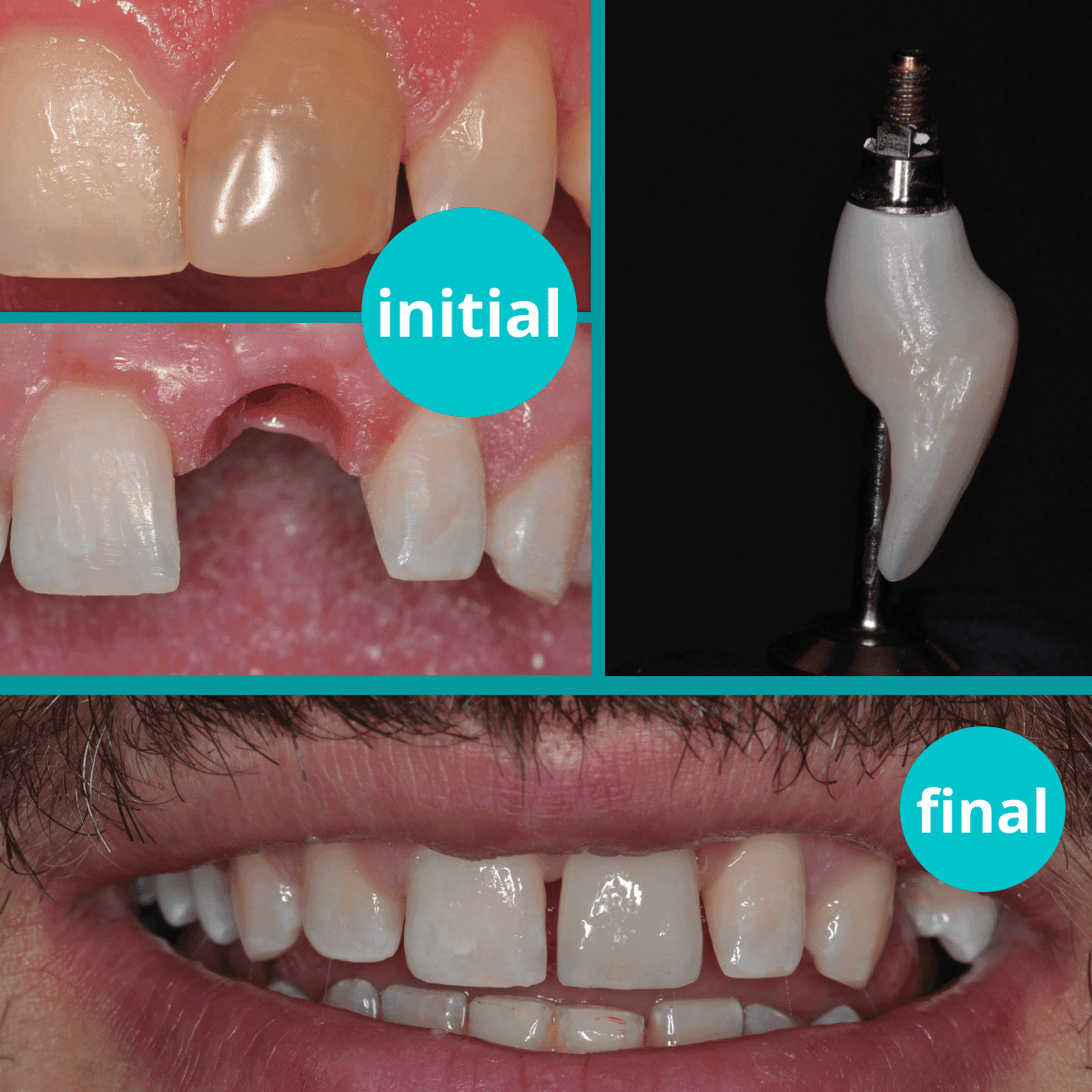 Implant postextractional cu provizorie imediată