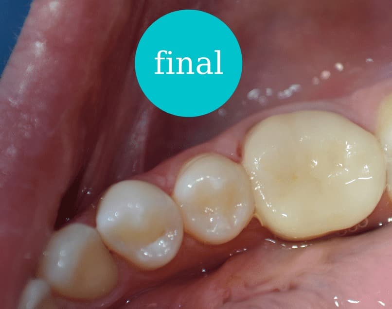 Onlay ceramic – rezultat final