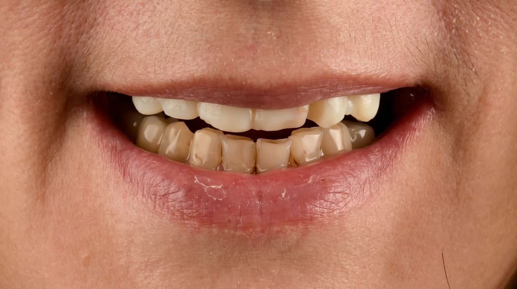 Refacerea estetică și funcțională a arcadelor dentare – starea inițială
