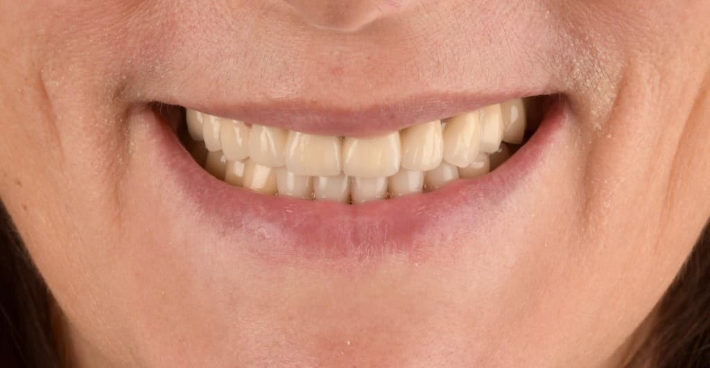 Refacerea estetică și funcțională a arcadelor dentare
