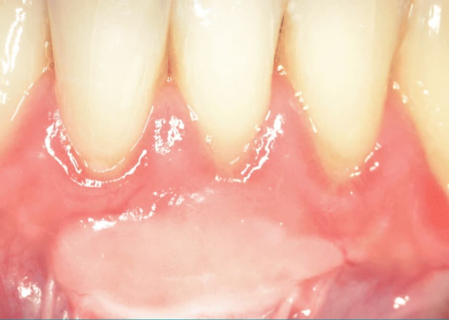 Regenerare gingivală 2 – rezultat final