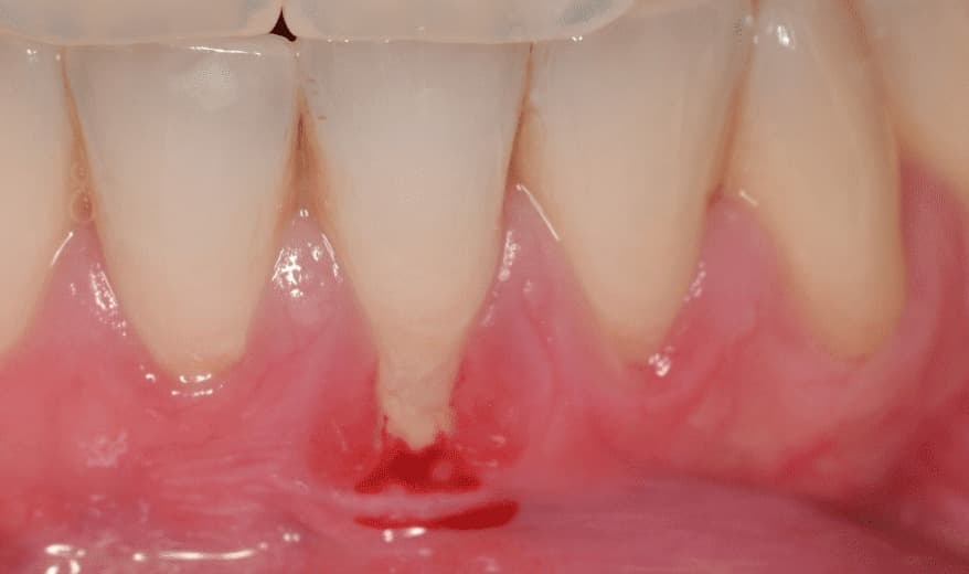 Regenerare gingivală 2 – starea inițială