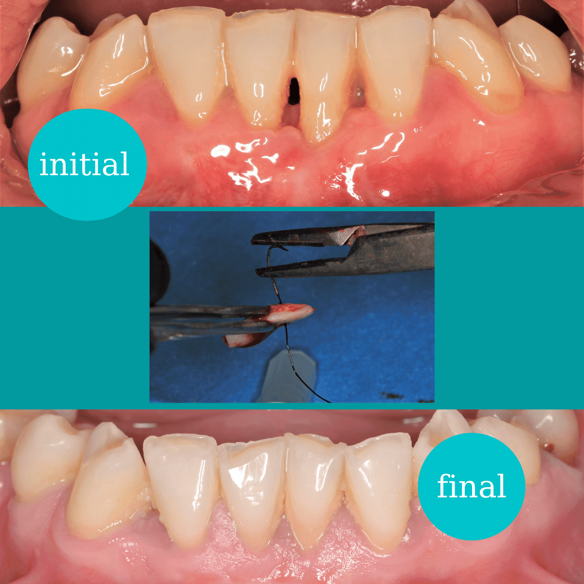 Regenerare gingivală