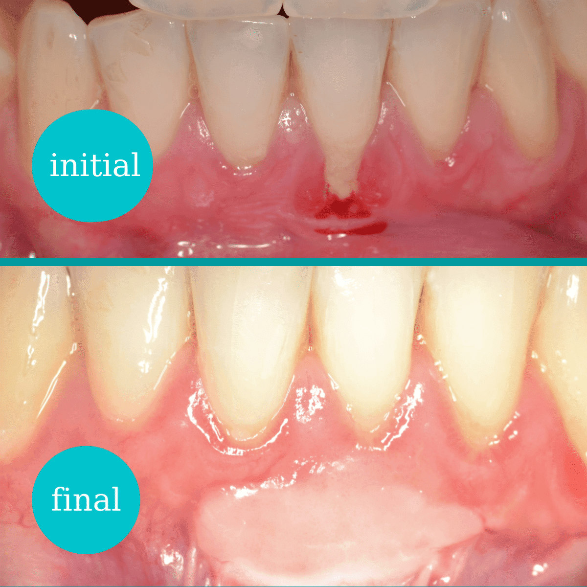 Regenerare gingivală 2
