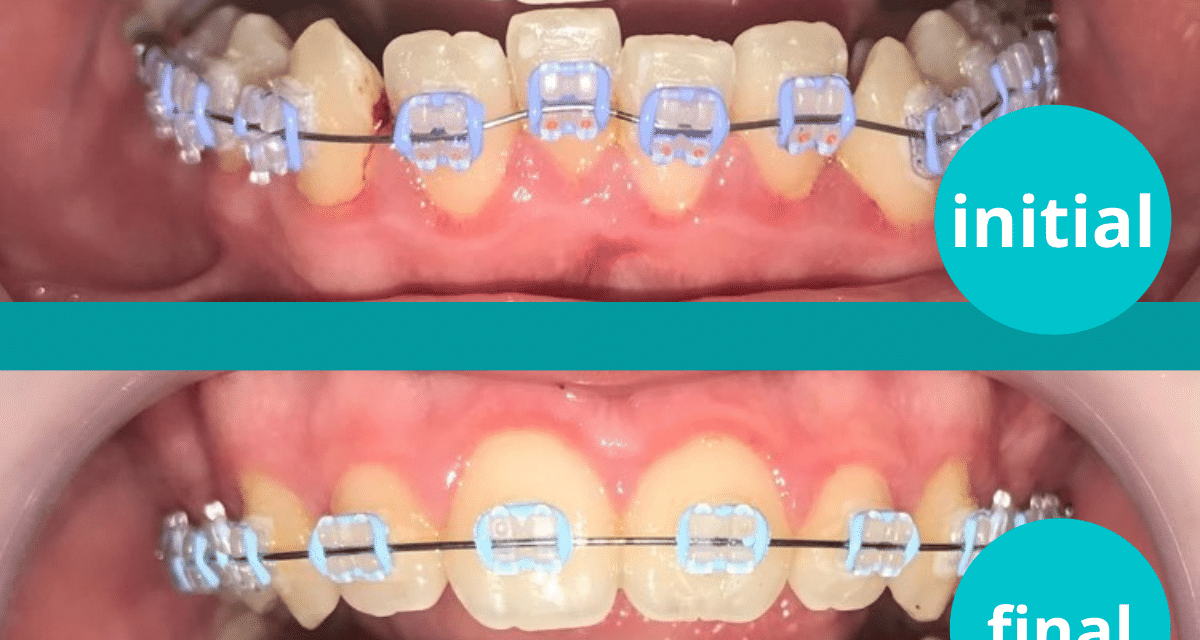 https://www.dentalcreation.ro/wp-content/uploads/2022/03/aparat-ortodontic-fix-rezultat-3-luni-dental-creation-timisoara-1200x640.png