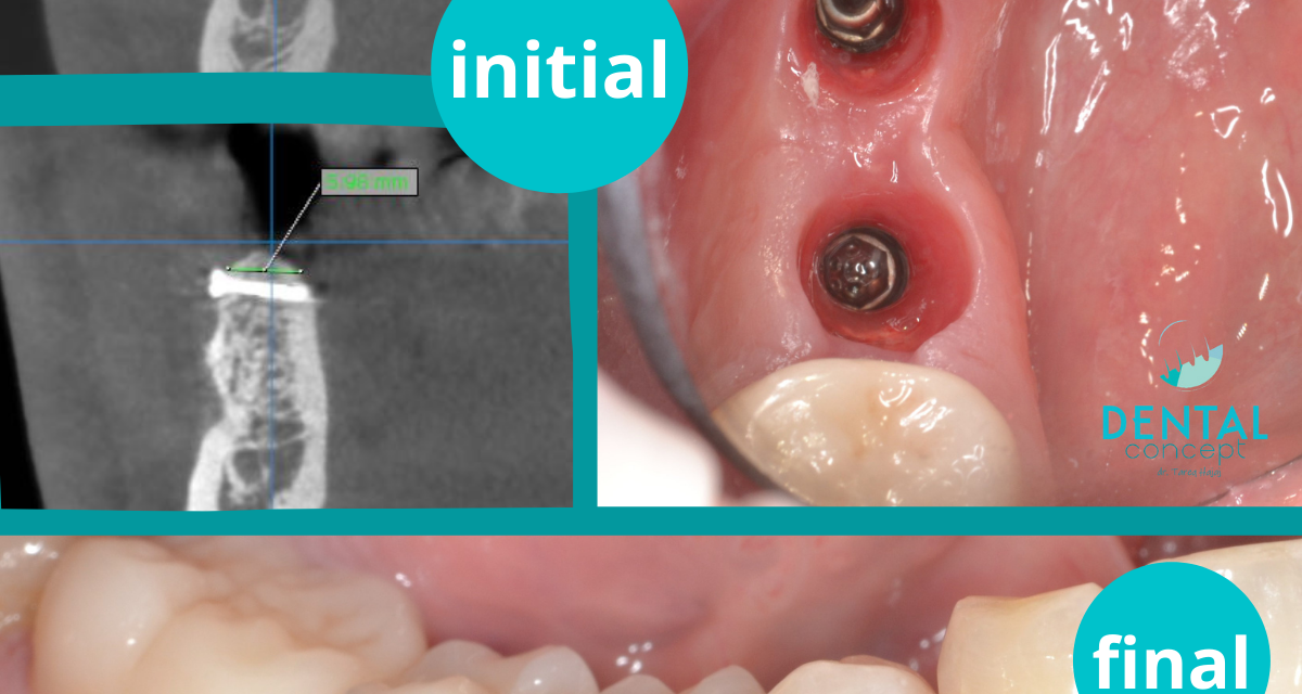 https://www.dentalcreation.ro/wp-content/uploads/2022/03/implantologie-caz-4-aditie-bone-plate-implante-dental-creation-1200x640.png