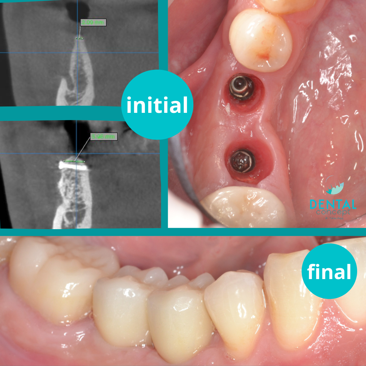 https://www.dentalcreation.ro/wp-content/uploads/2022/03/implantologie-caz-4-aditie-bone-plate-implante-dental-creation.png