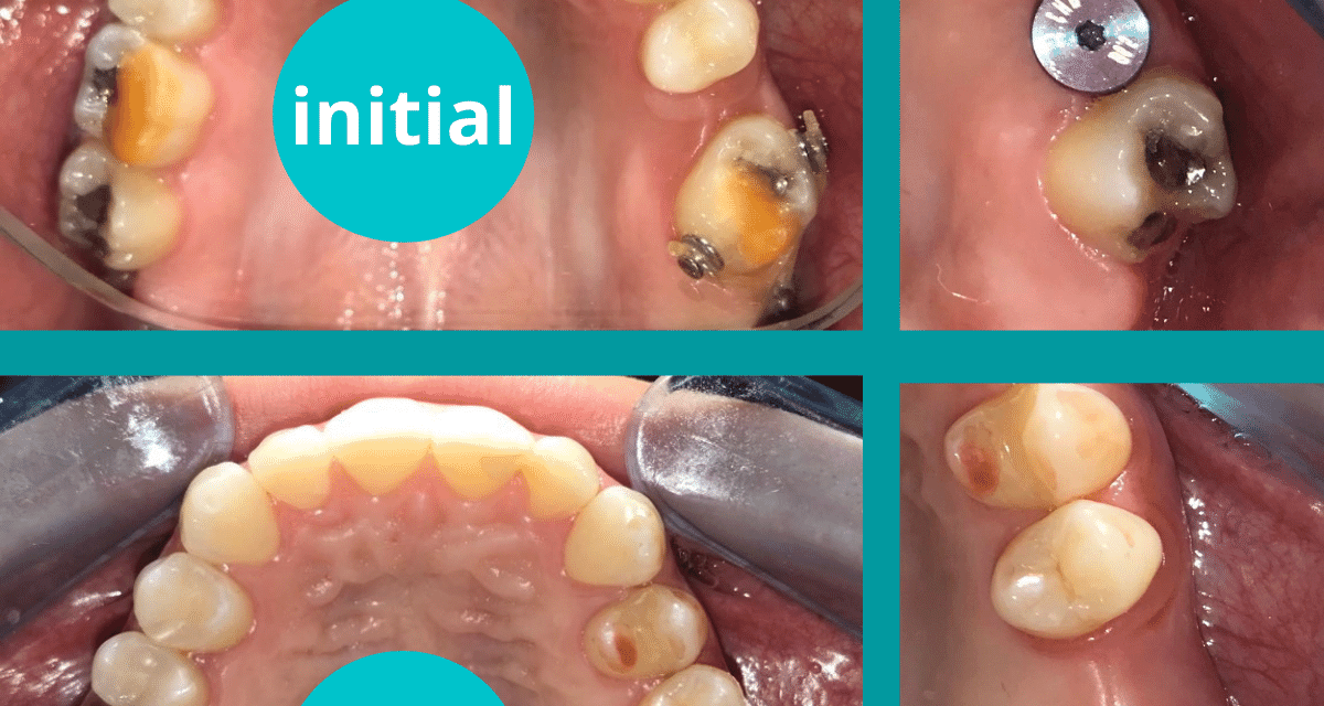 https://www.dentalcreation.ro/wp-content/uploads/2022/03/obtinerea-minim-invaziva-a-spatiului-ortodontie-dental-creation-timisoara-1200x640.png