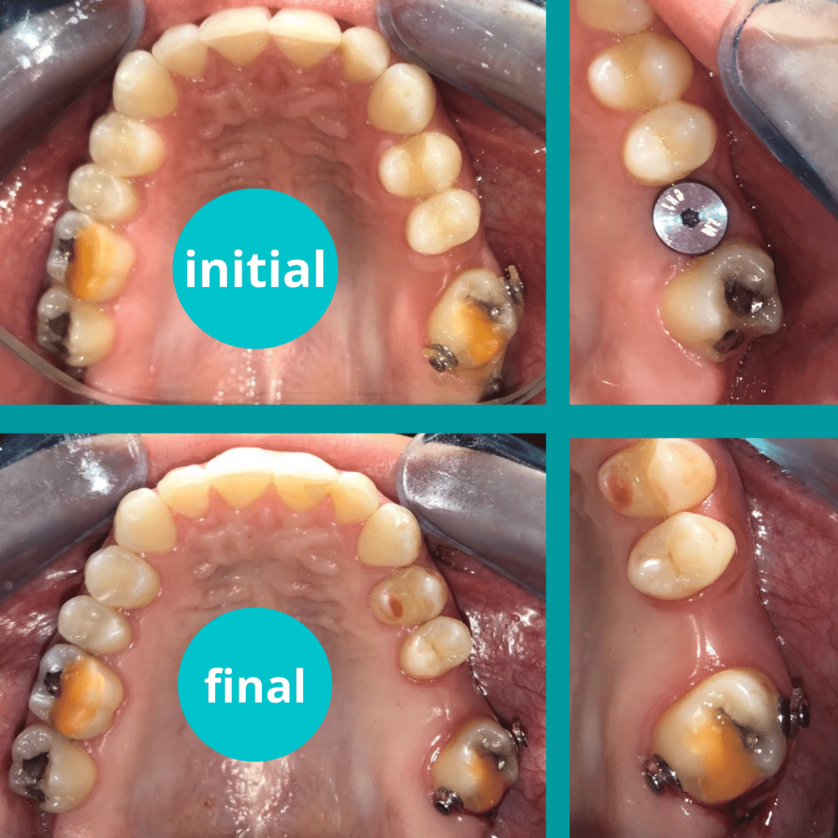 https://www.dentalcreation.ro/wp-content/uploads/2022/03/obtinerea-minim-invaziva-a-spatiului-ortodontie-dental-creation-timisoara.png