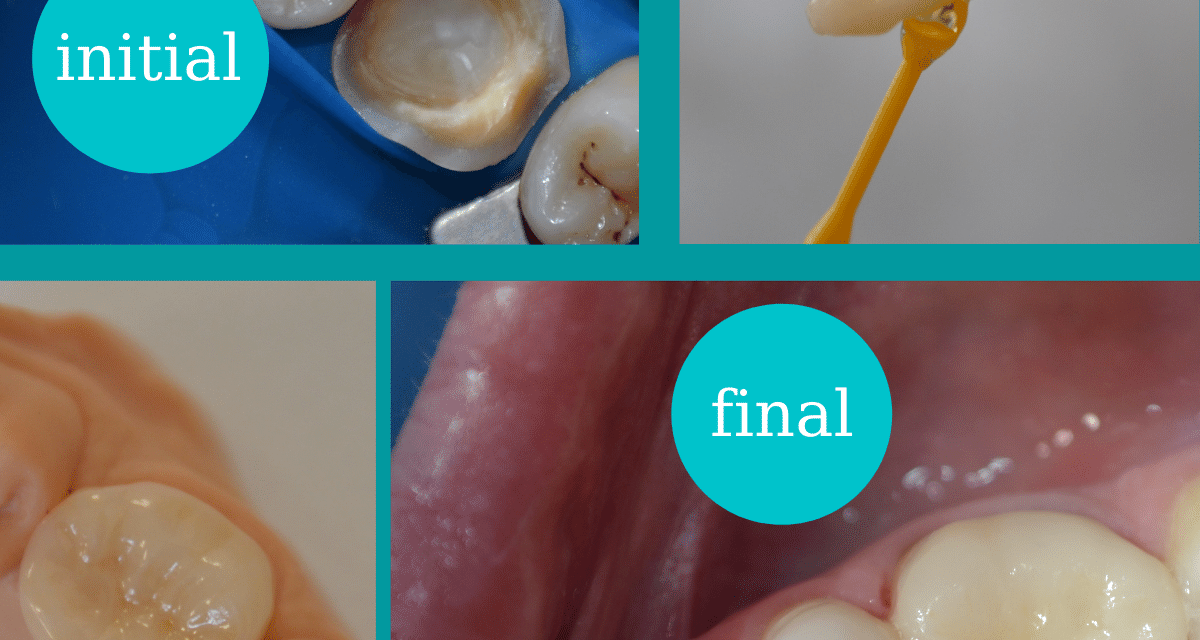 https://www.dentalcreation.ro/wp-content/uploads/2022/03/onlay-ceramic-detal-creation-timisoara-1200x640.png