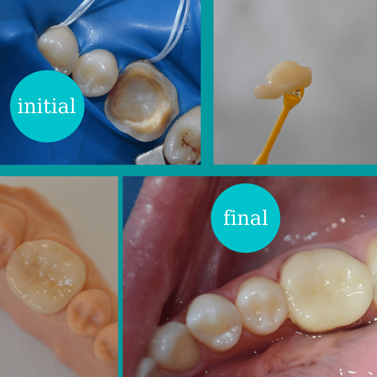 https://www.dentalcreation.ro/wp-content/uploads/2022/03/onlay-ceramic-detal-creation-timisoara.png