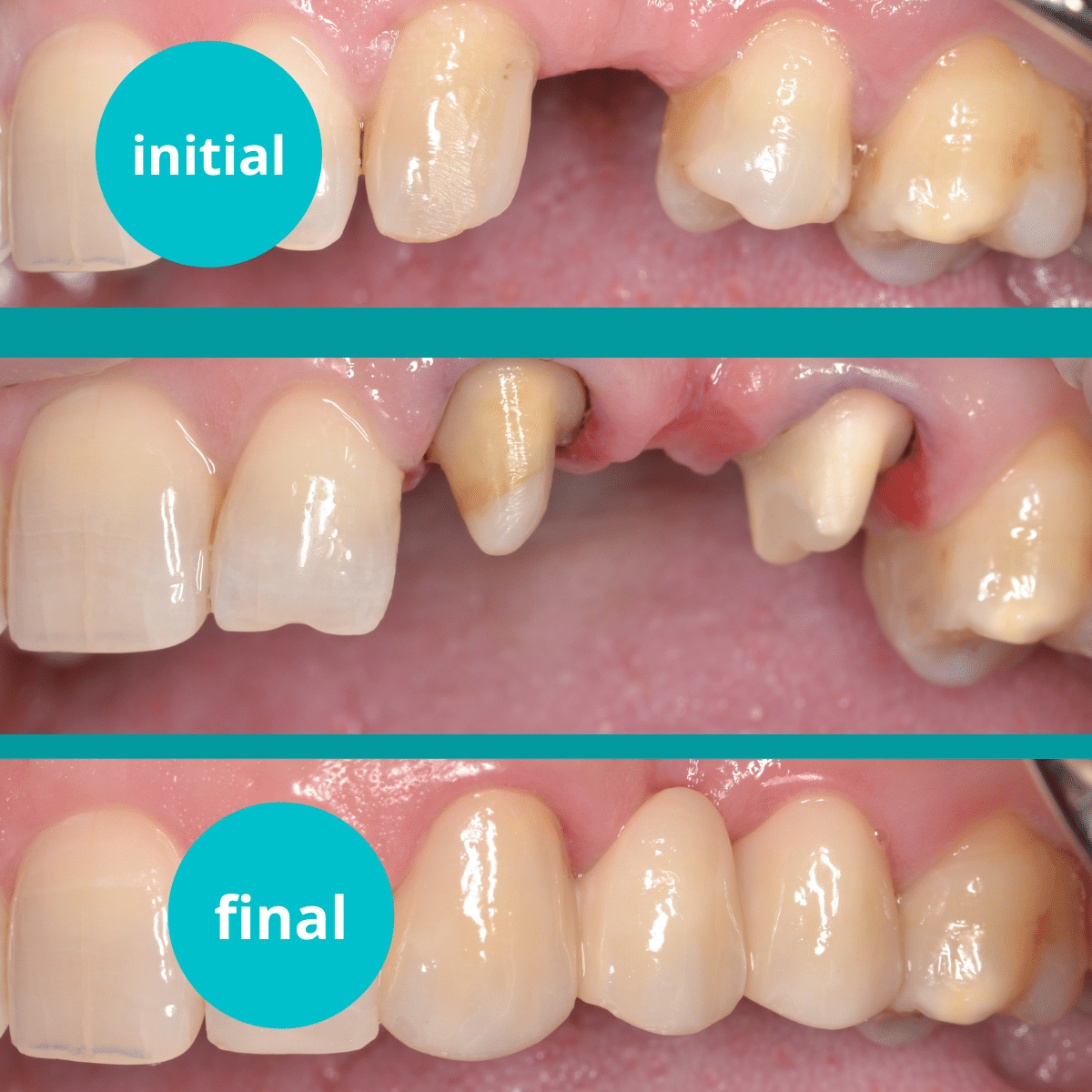 https://www.dentalcreation.ro/wp-content/uploads/2022/03/punte-fixa-zirconia-ceramica-dental-creation-clinic-timisoara.png