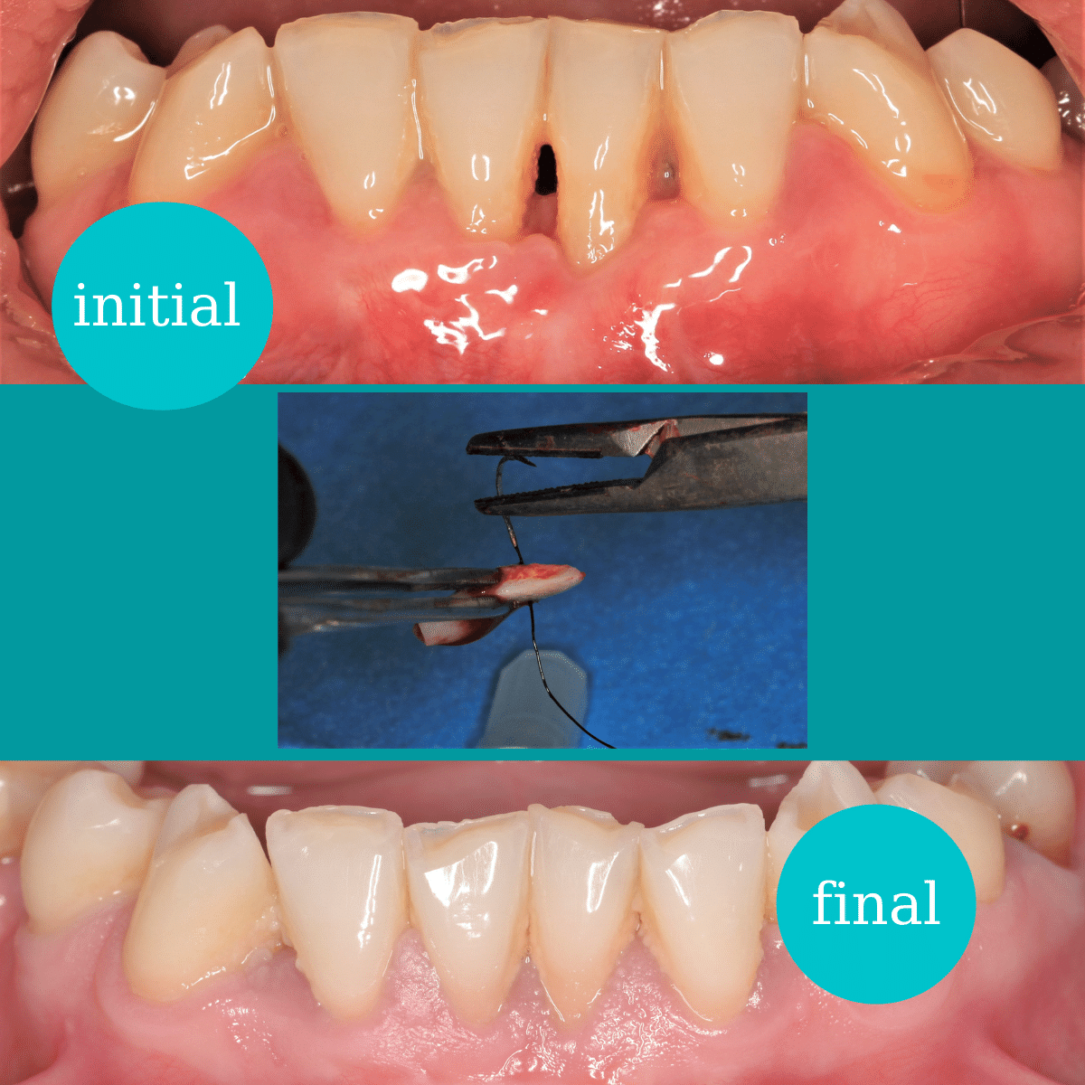 https://www.dentalcreation.ro/wp-content/uploads/2022/03/regenerare-gingivala-dental-creation-clinic-timisoara.png